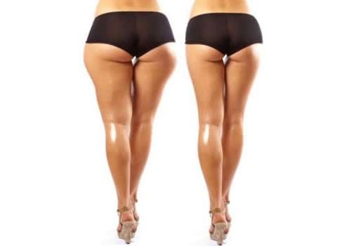 Bacak Liposuction