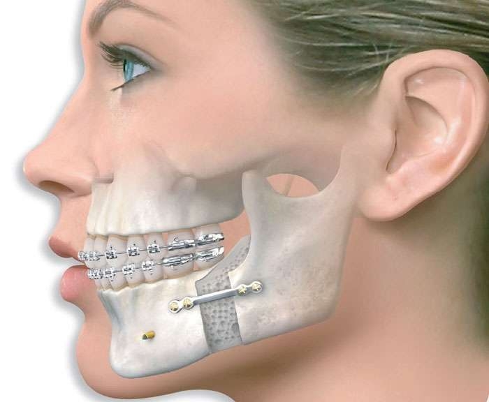 Lower Chin Fractures