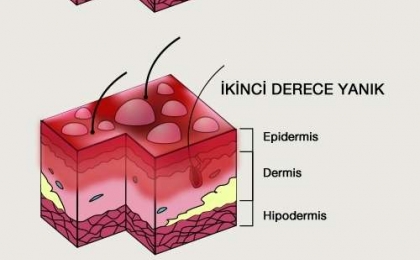 Degree of Burns (or Ambustion)