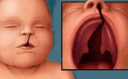 Congenital Lip and Cleft Palate 