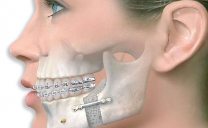 Lower Chin Fractures